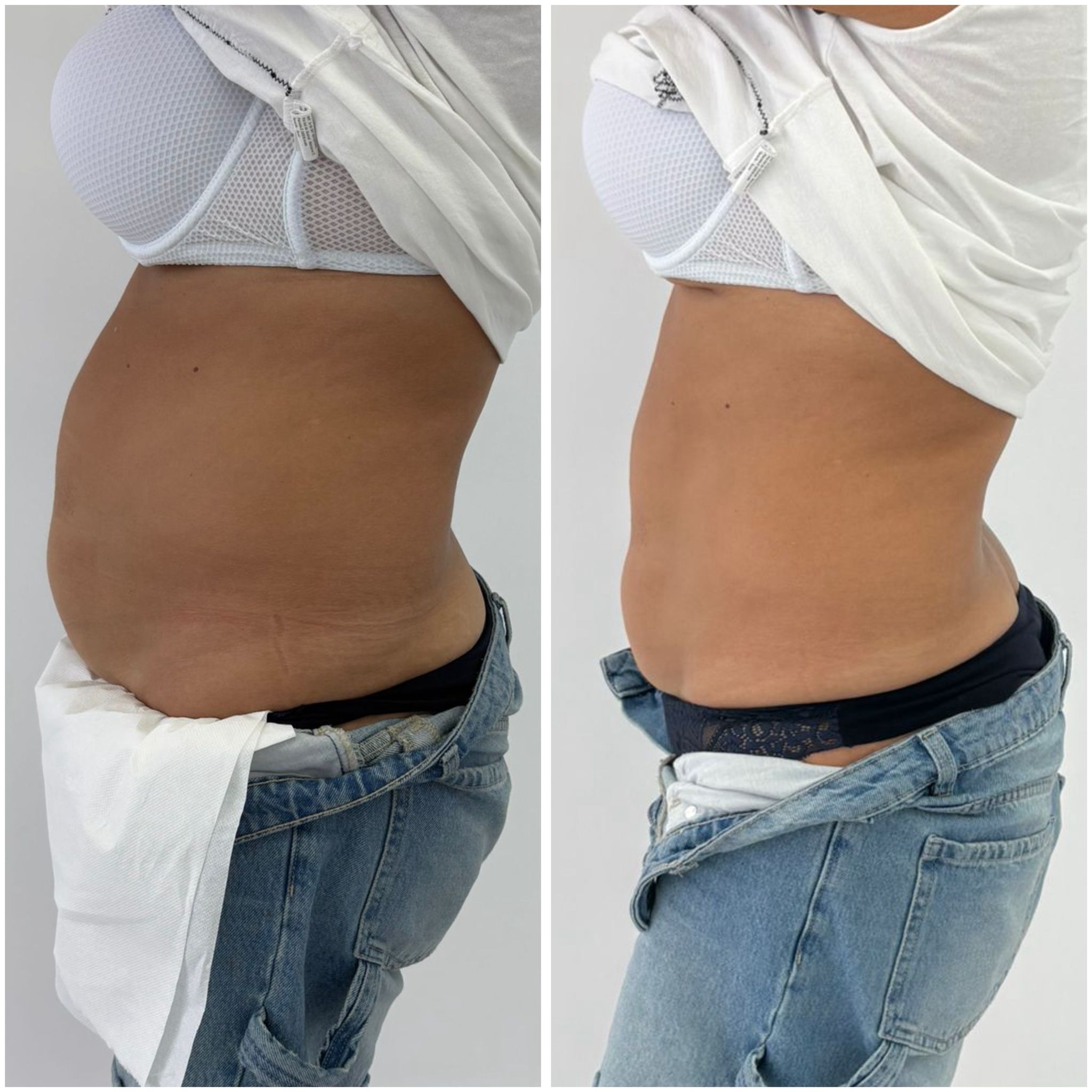 After LipoHIFU abdomen