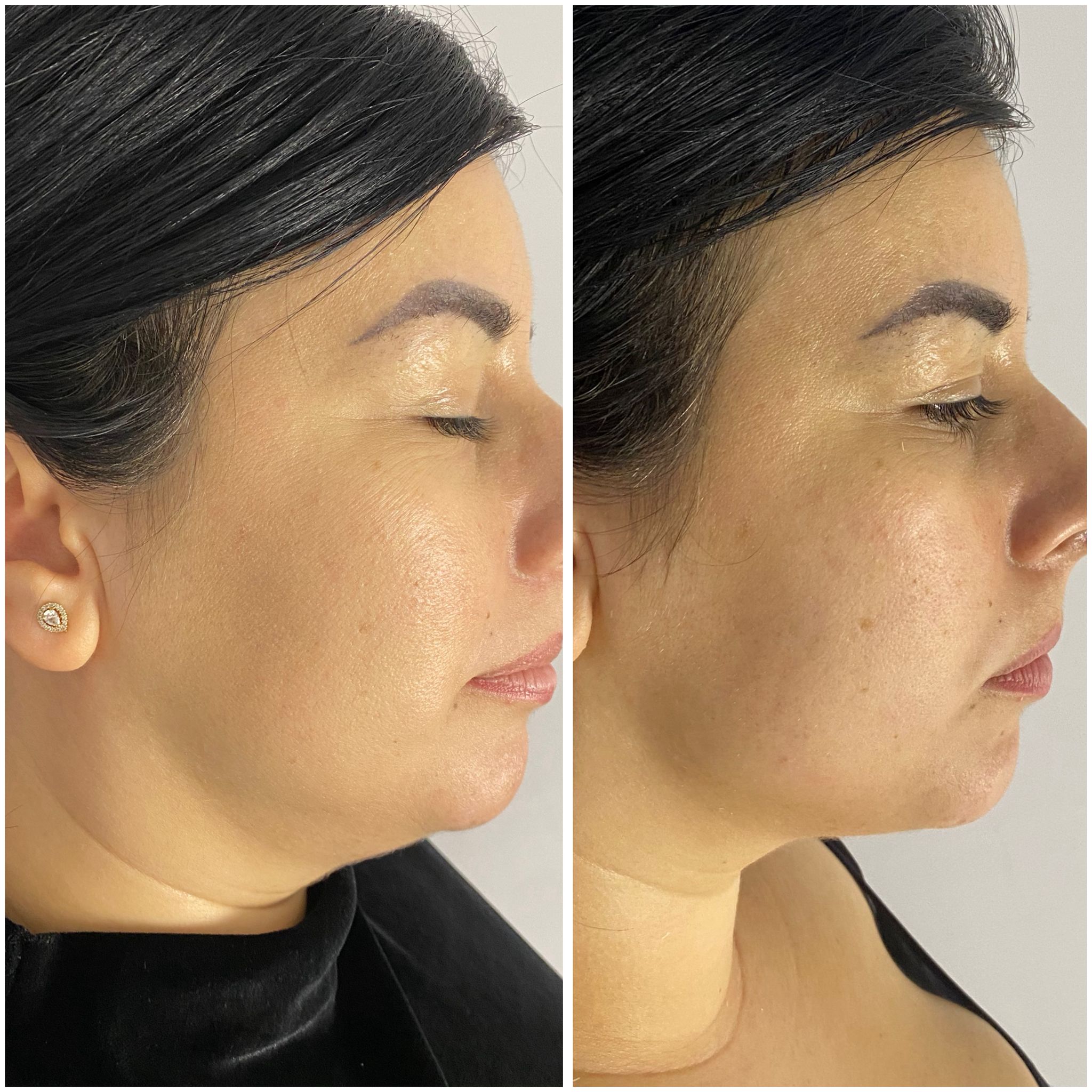 After HIFU lifting facial
