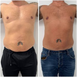 before and after lipo 2
