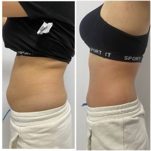 before and after lipo