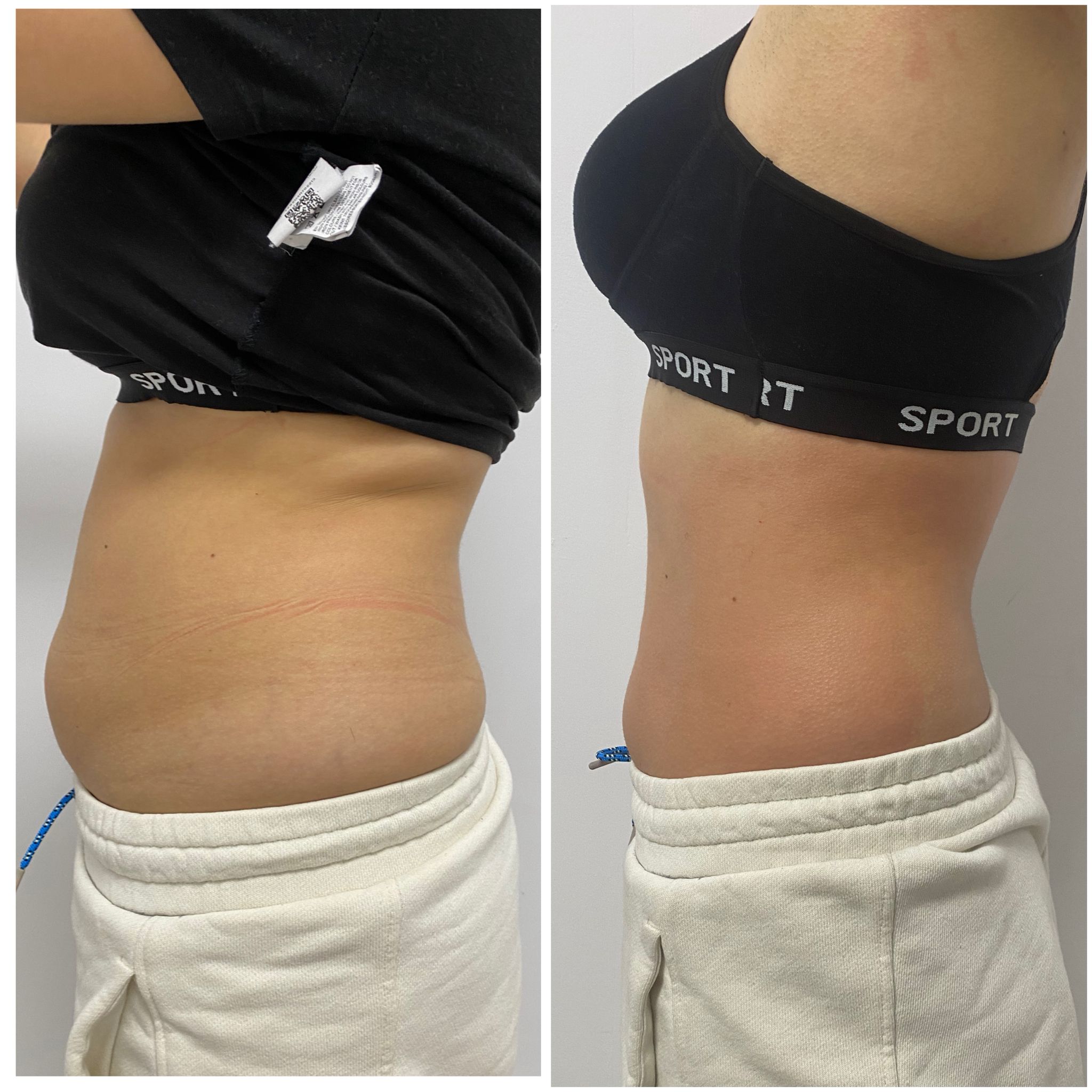 After Microneedling RF
