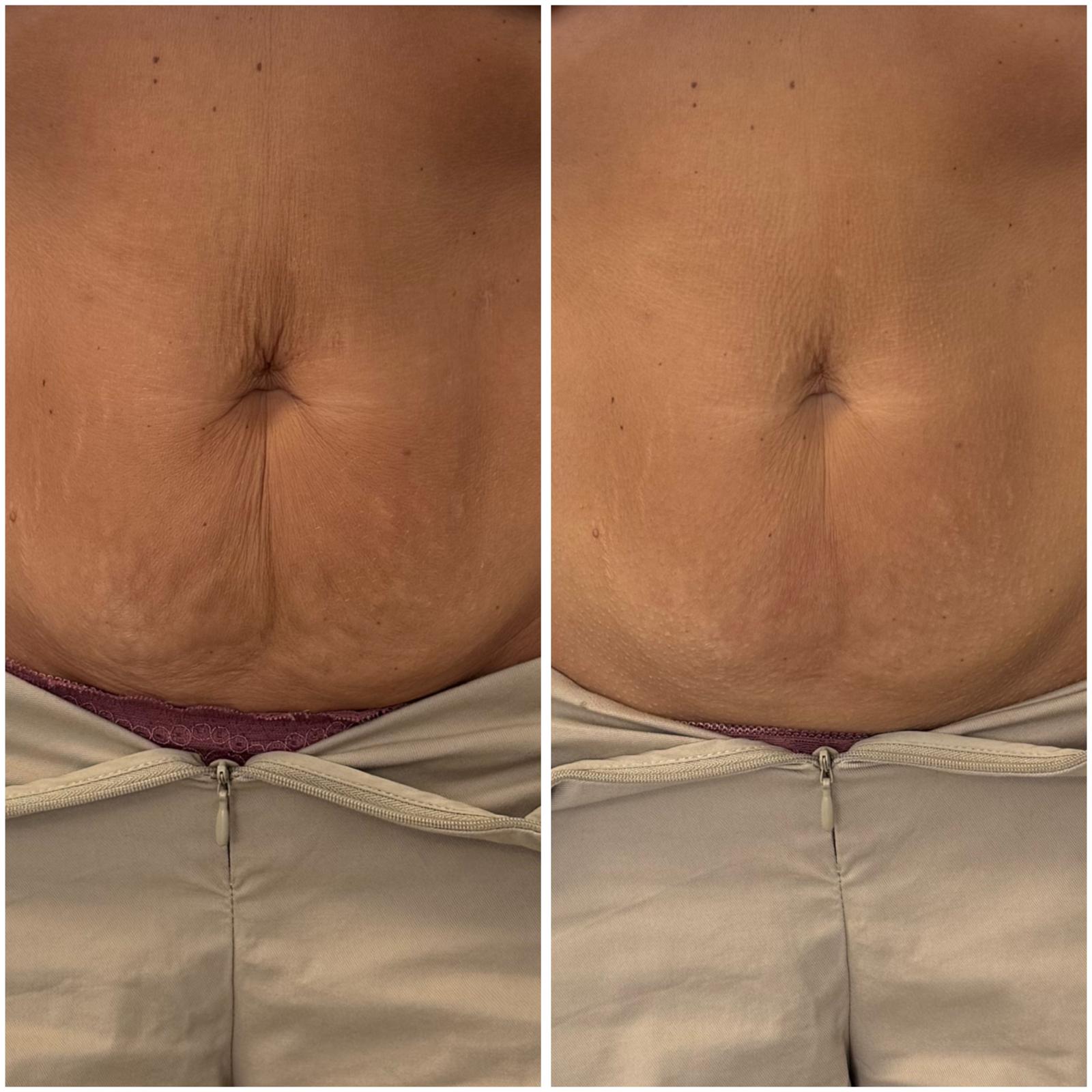 Rezultat remodelare abdomen OLIVERA