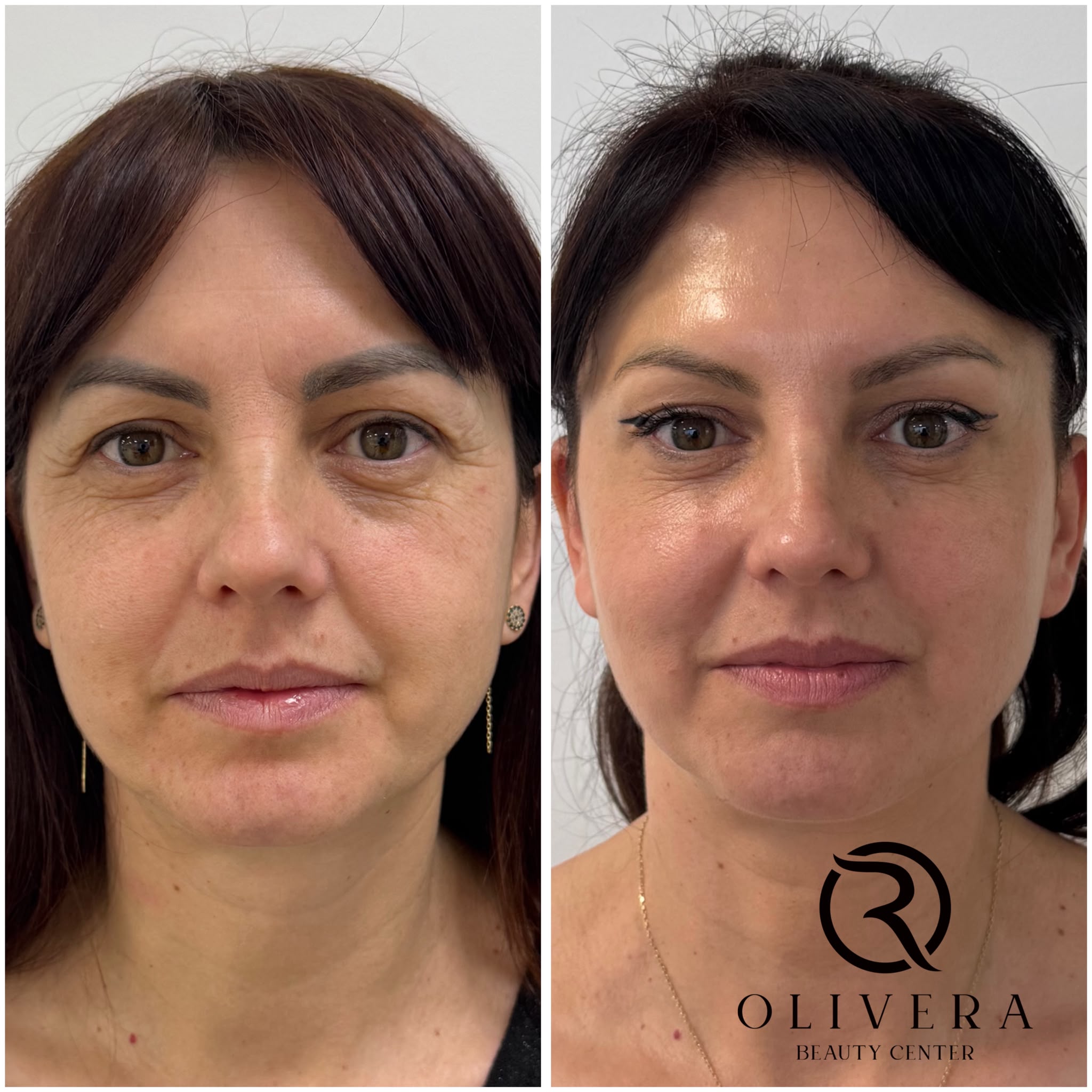 Rezultat rejuvenare facială OLIVERA