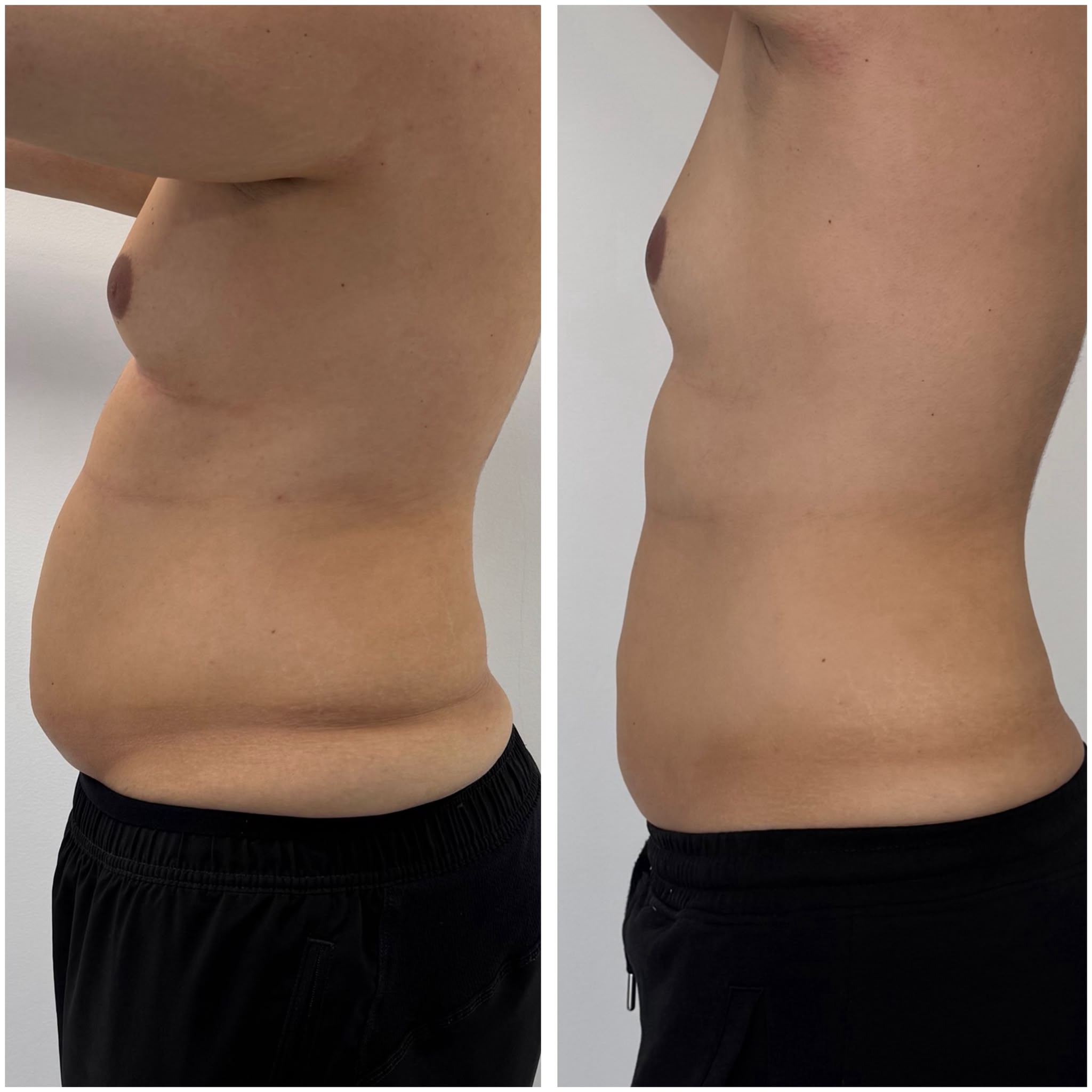 Rezultat remodelare LipoHIFU OLIVERA