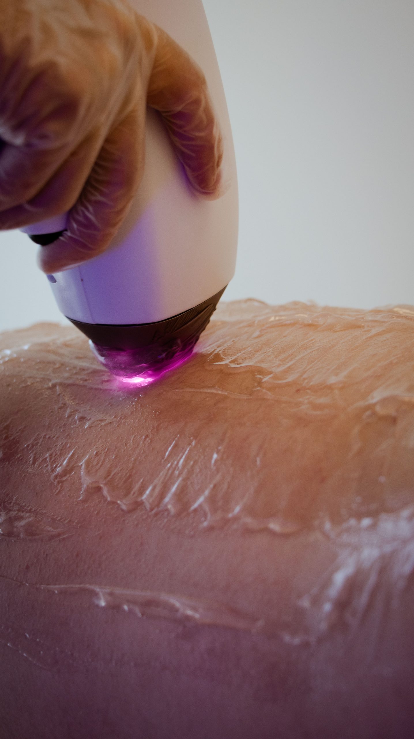 Epilare definitivă laser Olivera