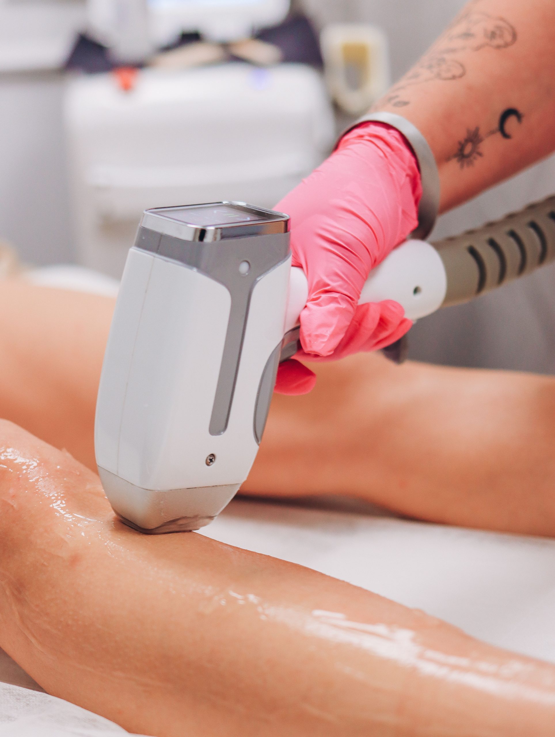 Rezultate epilare definitivă laser Olivera