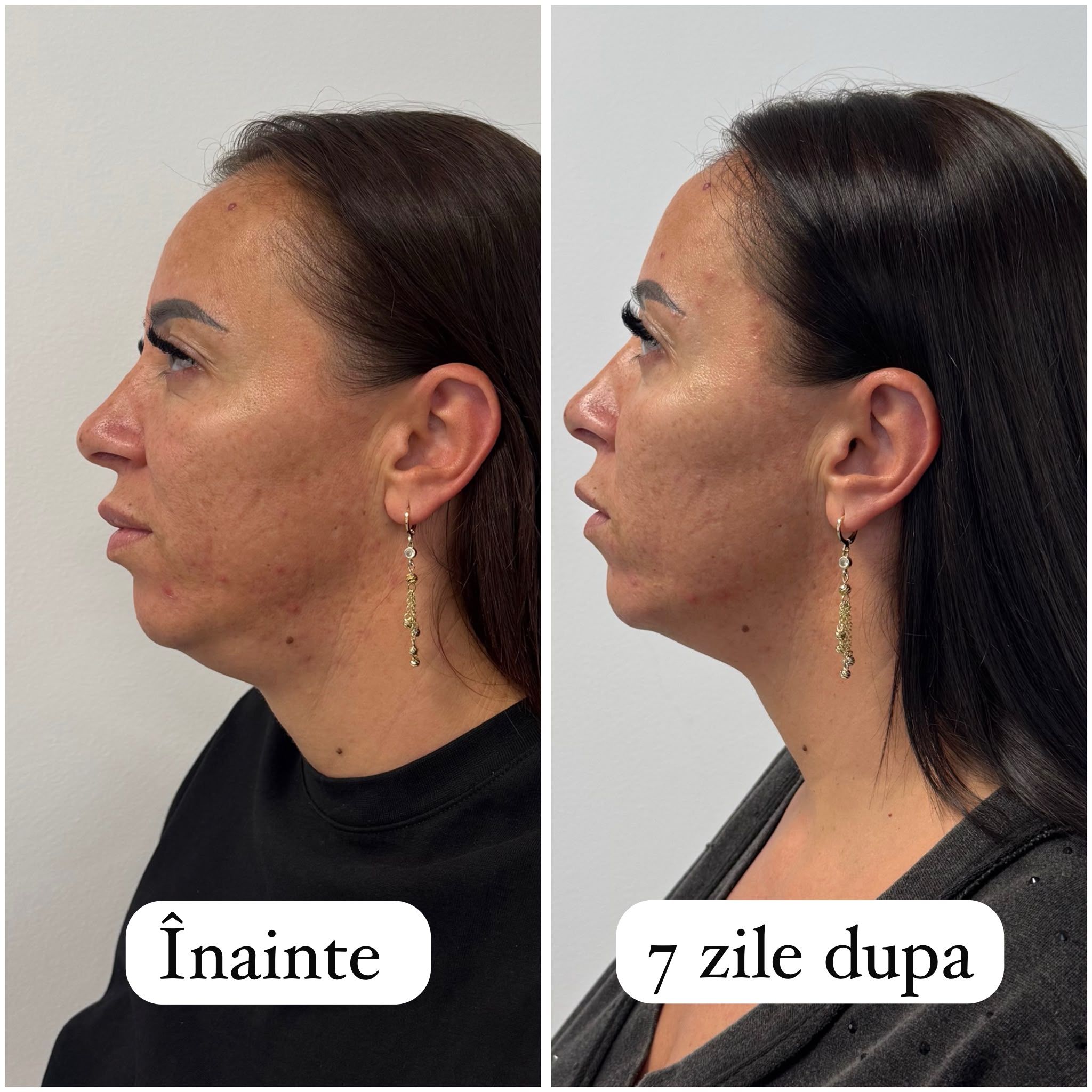 Rezultat lifting facial HIFU OLIVERA