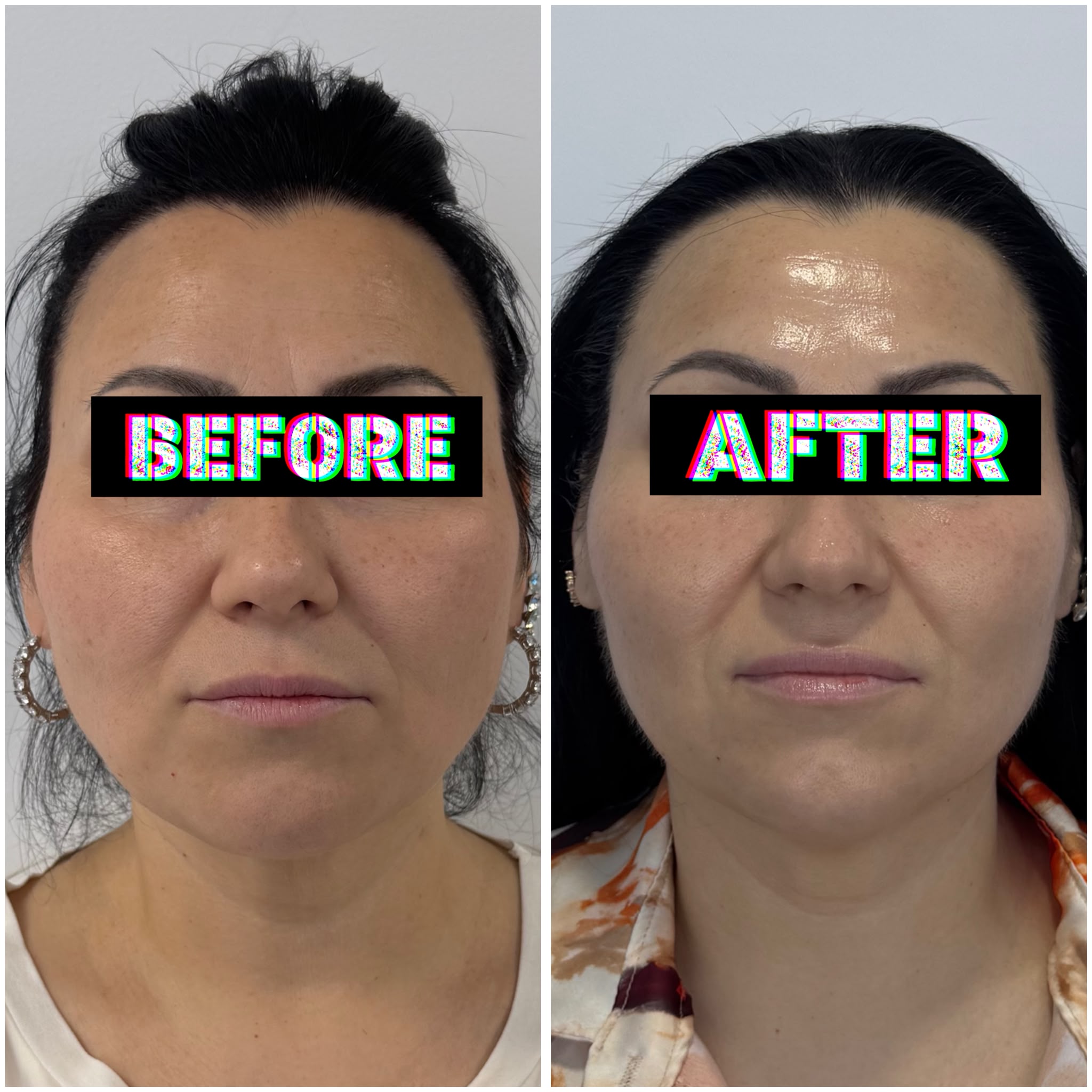 Rezultat înainte și după HIFU Facial - clienta 3