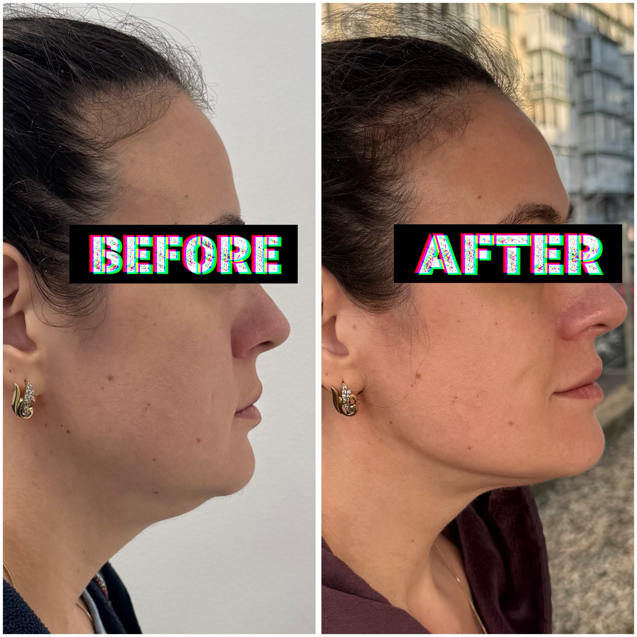 Rezultat înainte și după HIFU Facial - clienta 1