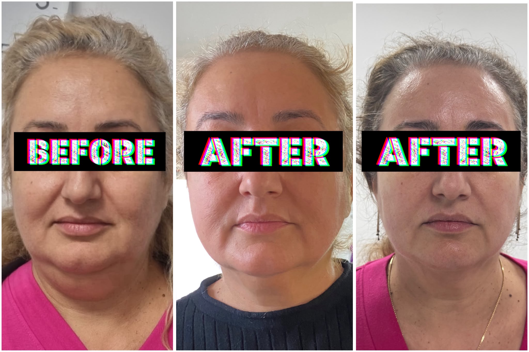 Rezultat înainte și după HIFU Facial - clienta 2